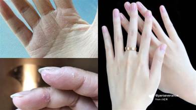 酒精消毒讓手紅腫、乾癢又脫皮！簡單「濕敷療法」4步驟，緩解乾洗手過敏後遺癥